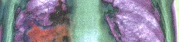 Salvador vai sediar III Simpósio Internacional Pós Mundial de Câncer de Pulmão