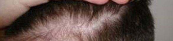 Células ricas em gordura podem levar à reversão da calvície, diz estudo