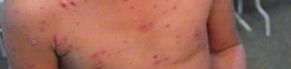 Bahia registra mais de 3 mil casos de catapora e crianças são mais afetadas