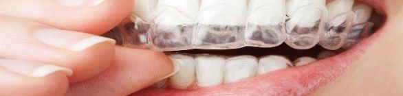 Clareadores dentais só podem ser vendidos com prescrição de um profissional