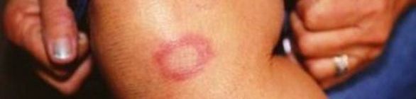 Saúde e OMS fazem mobilização nacional contra hanseníase