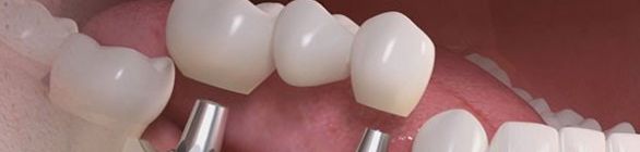 Mais segura e rápida que o implante convencional