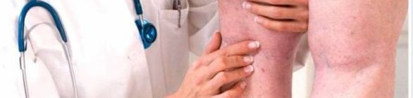 Trombose matou 171 pessoas na Bahia