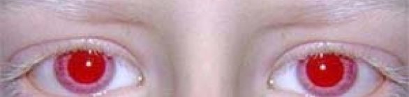 Atendimento dermatológico para pessoas com albinismo acontece nesta sexta (28)