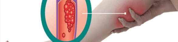 Trombose pode se manifestar durante e após a infecção do Sars-CoV-2