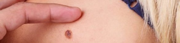 Diagnósticos de câncer de pele melanoma caem mais de 20% no último ano