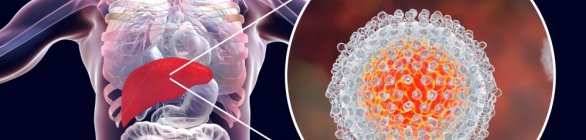  Hepatite, uma doença silenciosa